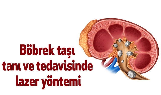 Böbrek taşı tanı ve tedavisinde lazer yöntemi