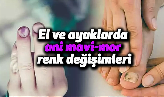El ve ayaklarda ani mavi-mor renk değişimleri