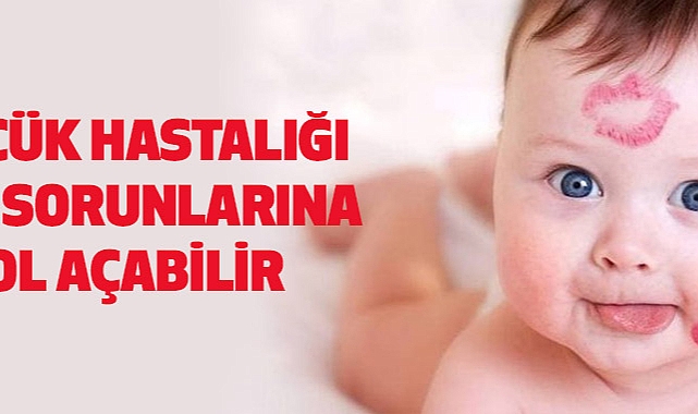 Öpücük hastalığı ciddi sorunlarına yol açabilir